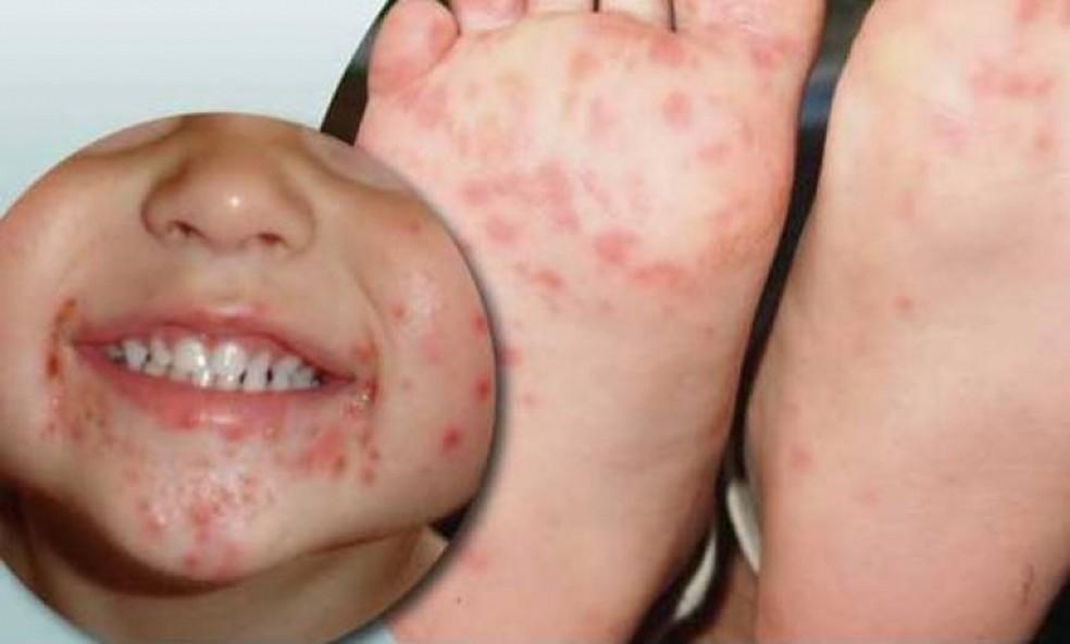 Surto da doença conhecida como mão-pé-boca é confirmado em duas cidades de MT