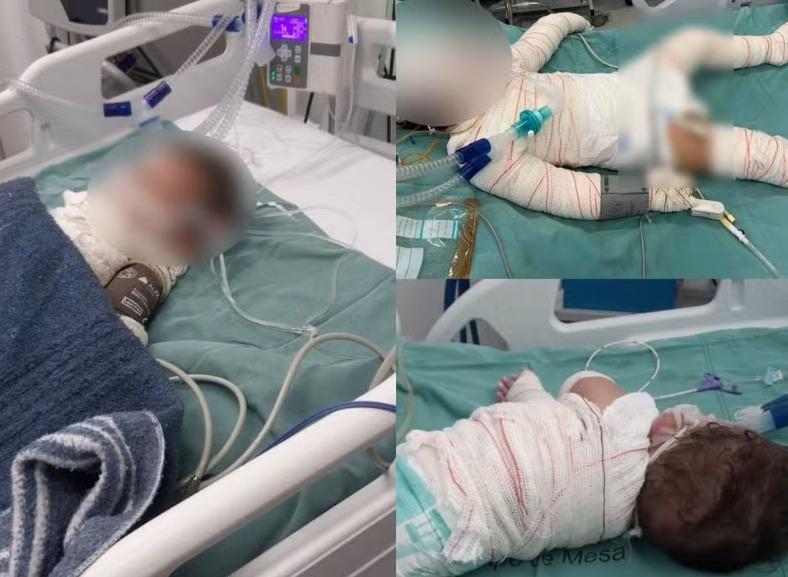 Churrasqueira acesa com álcool explode e deixa mãe e filhos em estado grave em MT