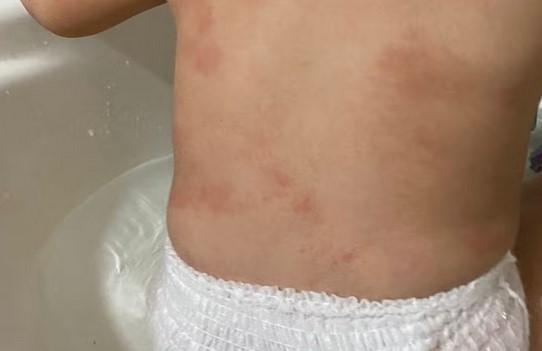 Mãe denuncia creche por maus-tratos após encontrar hematomas no corpo de filha de 1 ano em MT