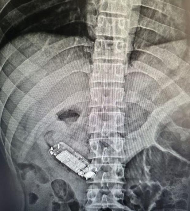 Detento passa por cirurgia após engolir celular em presídio de MT