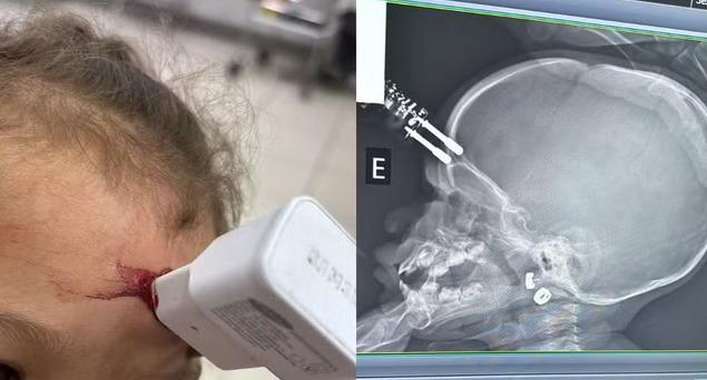 Menina de 1 ano fica com carregador cravado na testa após cair da cama em Divinópolis MG; imagem forte