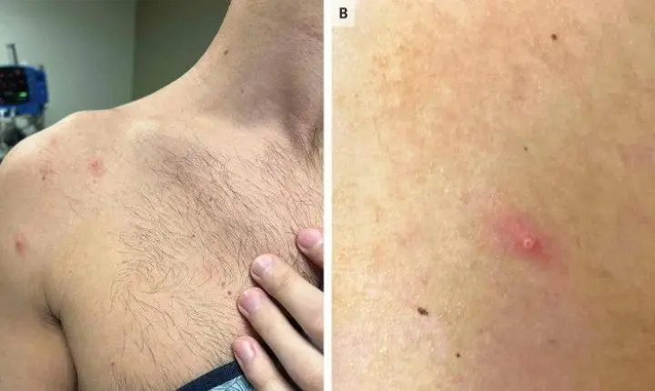 Brasil registra primeira morte por varíola do macaco fora do continente africano