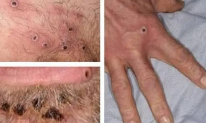 Brasil registra primeiros casos de transmissão comunitária da varíola do macaco