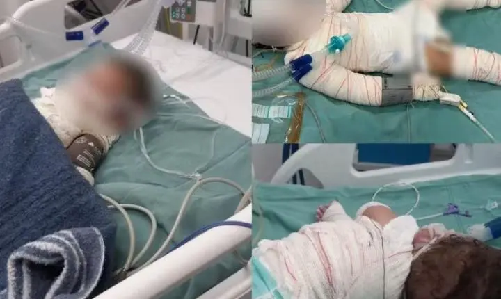 Churrasqueira acesa com álcool explode e deixa mãe e filhos em estado grave em MT