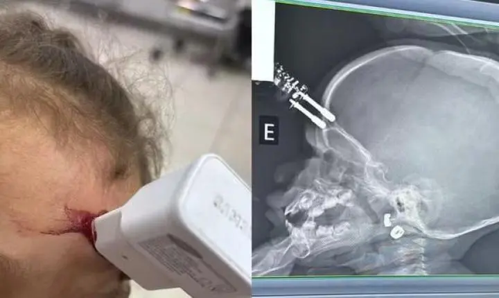 Menina de 1 ano fica com carregador cravado na testa após cair da cama em Divinópolis MG; imagem forte