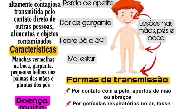 Secretaria de Saúde de Paranatinga notifica 01 caso da Síndrome Mão-Pé-Boca e faz alerta;