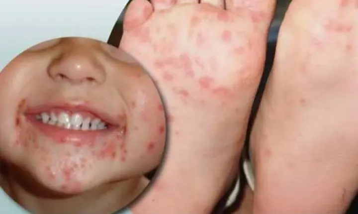 Surto da doença conhecida como mão-pé-boca é confirmado em duas cidades de MT